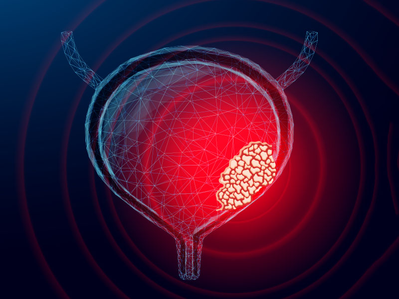 Strong Tools for a Strong Fight: MIBC Treatment Advances | Dr. Atul Narayankar Explains
